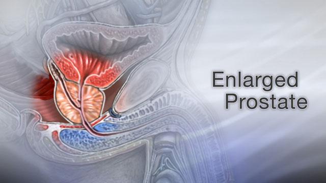 prostate enlargement and alcohol